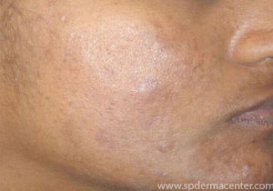 Acne-After